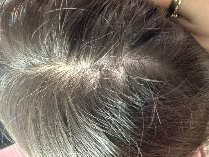 vši, hnidy - ilustračný obrázok